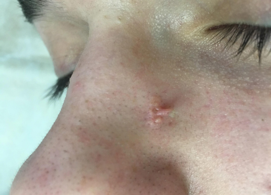 Пациент К., 18 лет. Себорейный невус Ядассона с кожным рогом на коже спинки носа. Вид сбоку